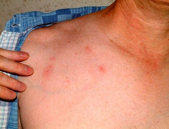 simptomi parazita ispod kože