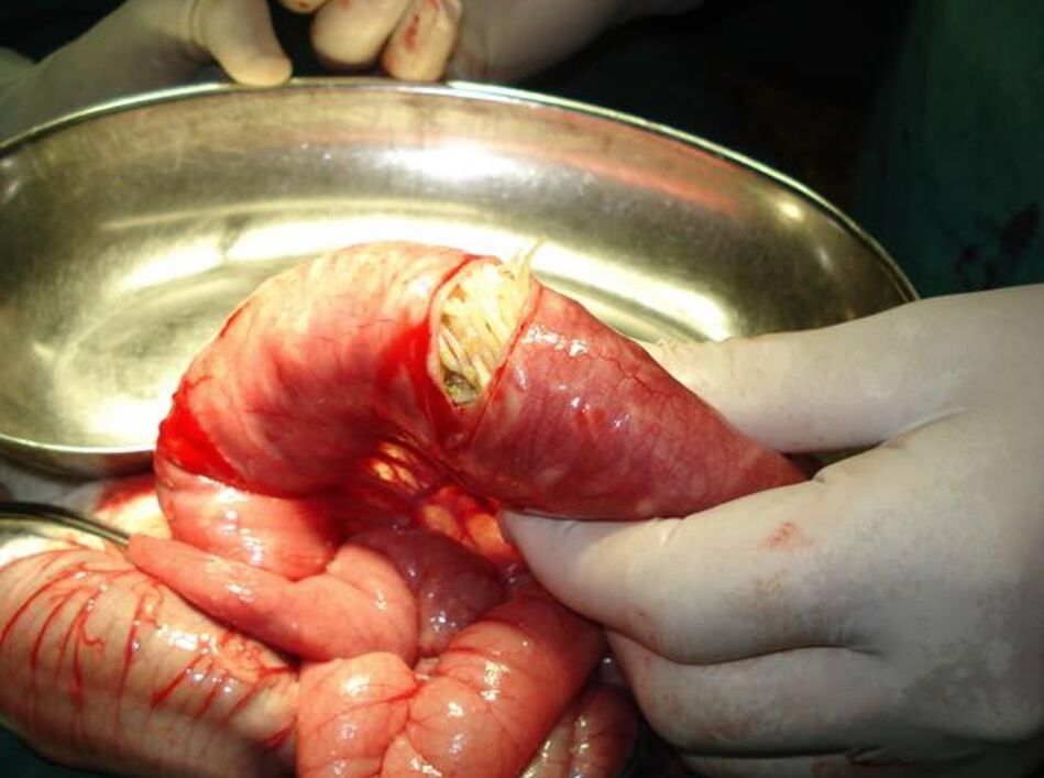 Okrugli crvi u ljudskom crijevu
